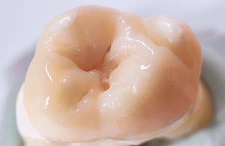 inainte de sigilarea dentara