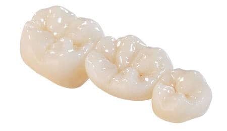 lucrari dentare portelan ceramica